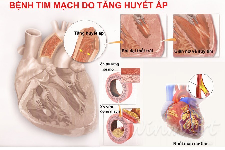 Sự ảnh hưởng của bệnh huyết áp cao tới sức khoẻ của con người